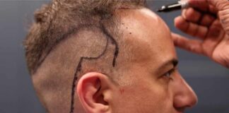 Natural Hairline Design Explained: A Surgeon's Step-by-Step
