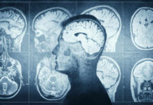 MRI scans of the brain displayed alongside a silhouette of a human head