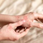 Skin Cells Run on Batteries: Science Explains How Close-up of a person's hands showing skin irritation and redness