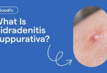 Hidradenitis Suppurativa, Explained: Symptoms, Causes, and Complications | GoodRx