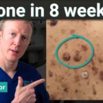 Seborrheic Keratosis Can a Gel Clear It? The Real Evidence