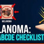 Skin Cancer Warning Signs: How to Spot Melanoma Early | Clinical Protocol
