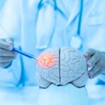Mayo’s Migraine Breakthrough—It’s Not Pills! Doctor examining a model of a brain with a pen