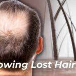 How to Stop Hair Loss: Science of Minoxidil & Finasteride