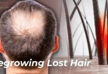 How to Stop Hair Loss: Science of Minoxidil & Finasteride