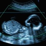 Fetal ultrasound scan image